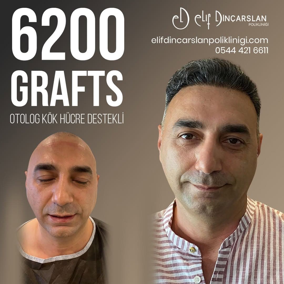Gerçek hasta saç ekimi öncesi ve sonrası sonucu